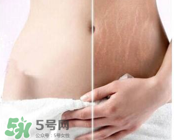 妊娠紋怎么長在大腿上了？妊娠紋會不會長在大腿上？