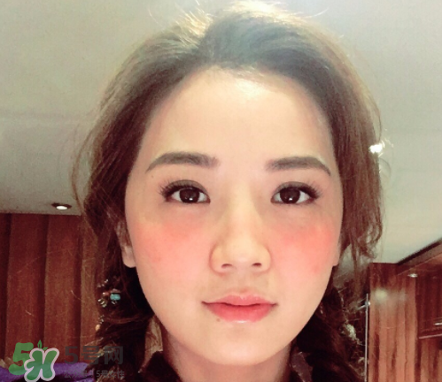 夏天可以點痣嗎？夏天點痣后要注意什么？