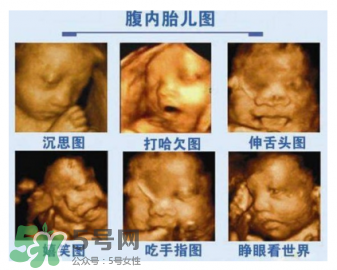 四維彩超有必要做嗎？四維彩超檢查不出什么？