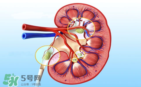 腎結石有什么癥狀？腎結石原因
