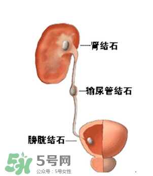 腎結石有什么癥狀？腎結石原因