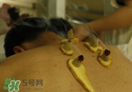 三伏灸有用嗎？2017年三伏艾灸時間