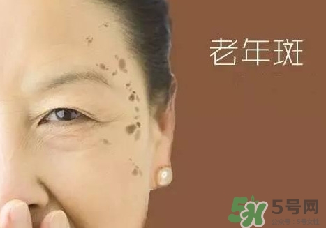 老年斑多大年齡開始有？為什么牙膏能去老年斑？