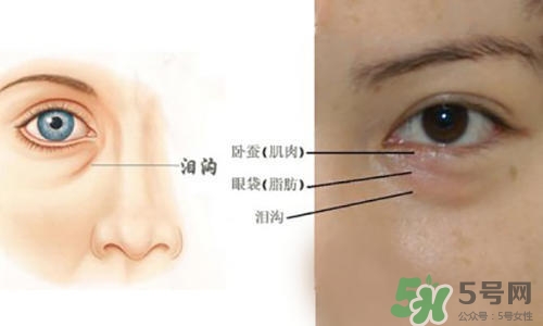 淚溝能自己恢復(fù)嗎？淚溝怎么自己恢復(fù)？
