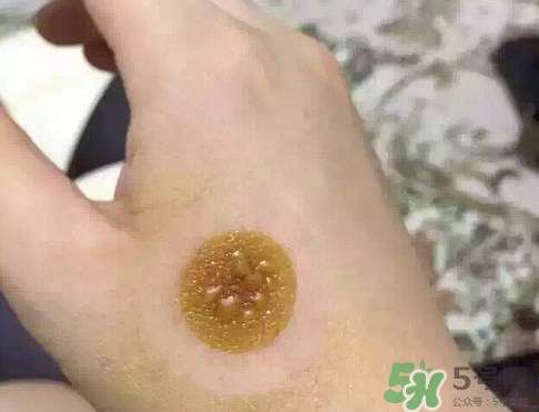 艾灸貼后有水泡怎么辦？貼艾灸貼應(yīng)注意些什么？