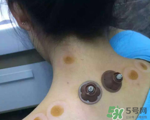 艾灸貼后有水泡怎么辦？貼艾灸貼應(yīng)注意些什么？