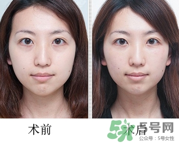 填充淚溝有風(fēng)險嗎？填充淚溝的方法