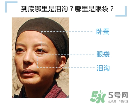 玻尿酸填充淚溝多久恢復自然？玻尿酸填充淚溝的危害