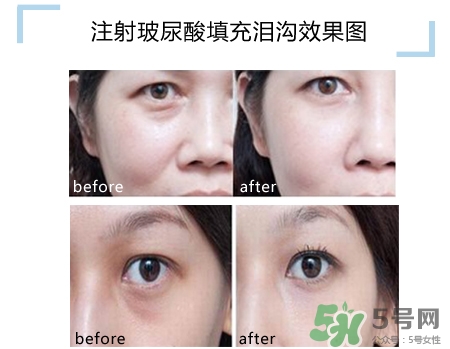 玻尿酸填充淚溝多久恢復自然？玻尿酸填充淚溝的危害