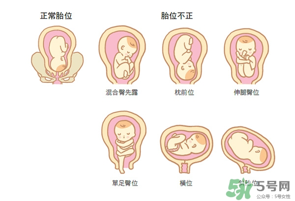 胎位不正如何矯正？胎位不正一定要剖腹產(chǎn)嗎？