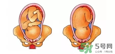 胎位不正能順產(chǎn)嗎？胎位不正怎么辦？