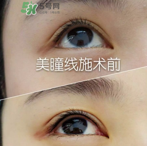做美瞳線可以吃雞蛋嗎？做美瞳線能吃雞蛋嗎？