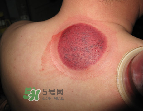 三伏天拔罐后多久可以洗澡？三伏天拔罐后注意事項(xiàng)