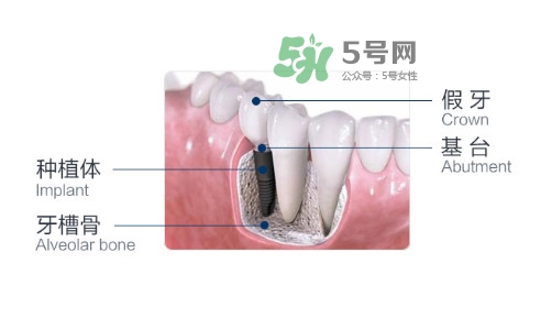 種植牙費(fèi)用多少錢(qián)？國(guó)產(chǎn)種植牙價(jià)格