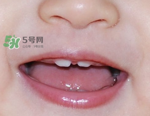 牙齒縫隙大怎么辦？牙縫大帶牙套有用嗎