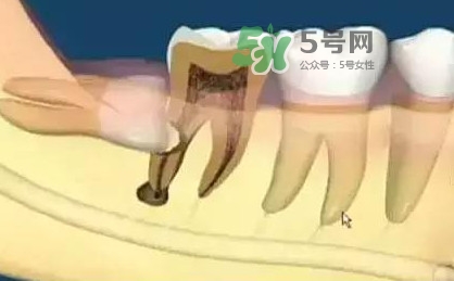 智齒是每個人都會長嗎？拔智齒能瘦臉嗎？