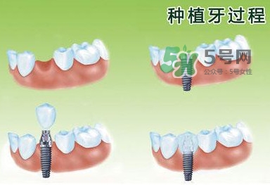 種植牙費(fèi)用多少錢(qián)？國(guó)產(chǎn)種植牙價(jià)格