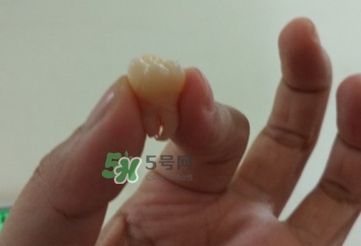 拔智齒痛嗎？智齒拔了多久洞會好？
