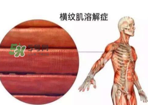 橫紋肌溶解癥會(huì)死亡嗎？橫紋肌溶解癥能活多久