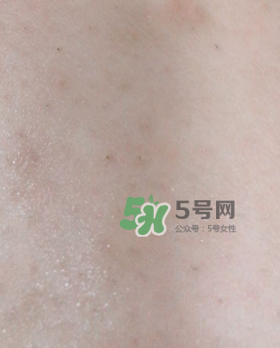 Dermatix舒痕疤痕膏有效嗎？Dermatix舒痕疤痕膏怎么用？
