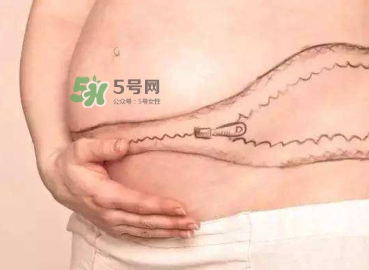 剖腹產(chǎn)疤痕怎么去除？剖腹產(chǎn)疤痕能去掉嗎？