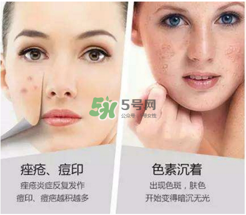 果酸換膚自己可以做嗎？果酸換膚后注意事項(xiàng)
