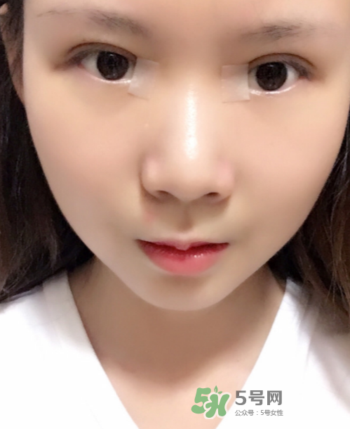 美皮護(hù)去疤效果怎么樣？美皮護(hù)有用嗎？
