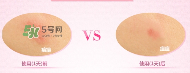 3m痘痘貼怎么用？3m痘痘貼貼多久？