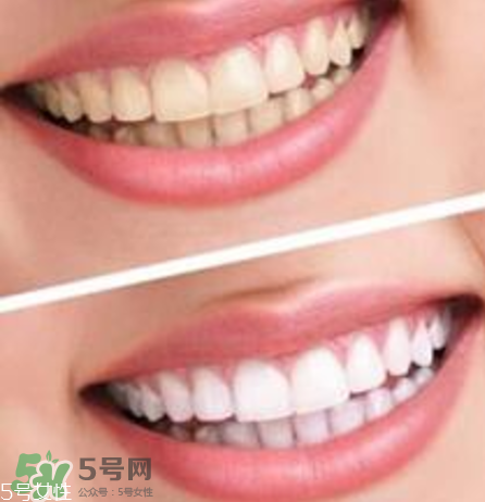 碧緹福美牙儀對牙齒有傷害嗎？碧緹福美牙儀會反彈嗎？