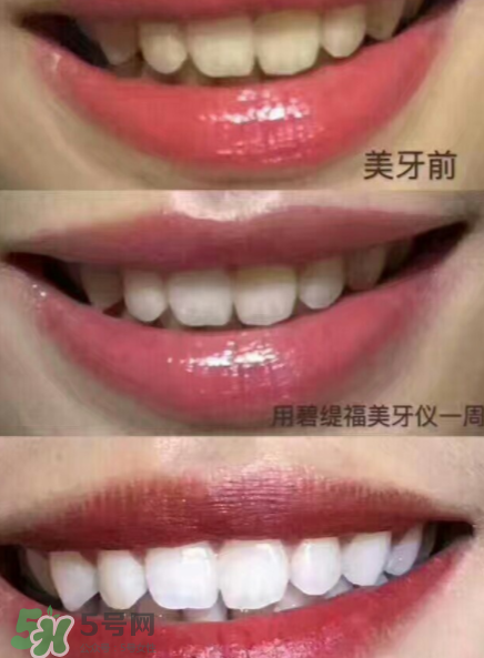 美牙儀能用水洗嗎？美牙儀能用多久？