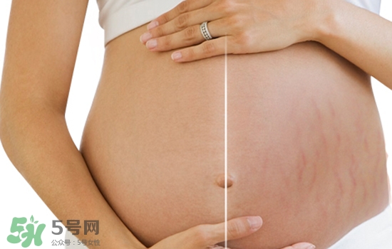 妊娠紋在左邊生男或女？怎么從妊娠紋看男女？