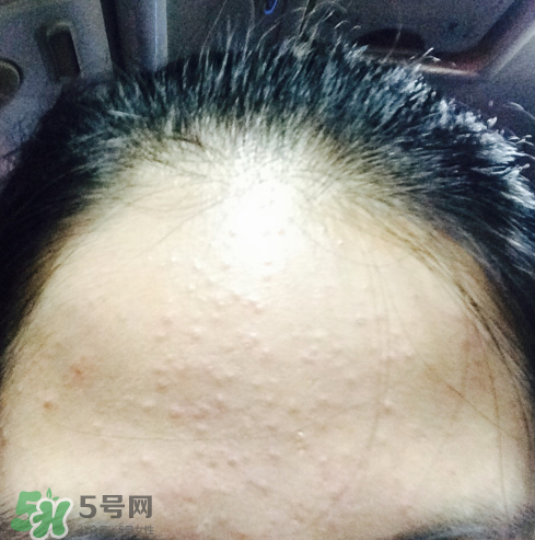 長(zhǎng)痘長(zhǎng)閉口怎么辦？長(zhǎng)痘長(zhǎng)閉口是什么原因？