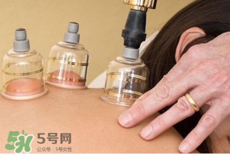 真空拔罐有用嗎？真空拔罐多長時間合適