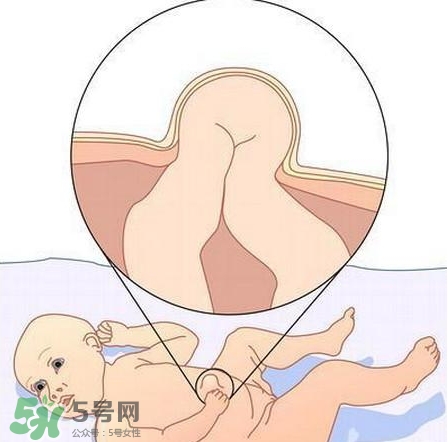 臍疝是什么？臍疝對寶寶有什么影響？