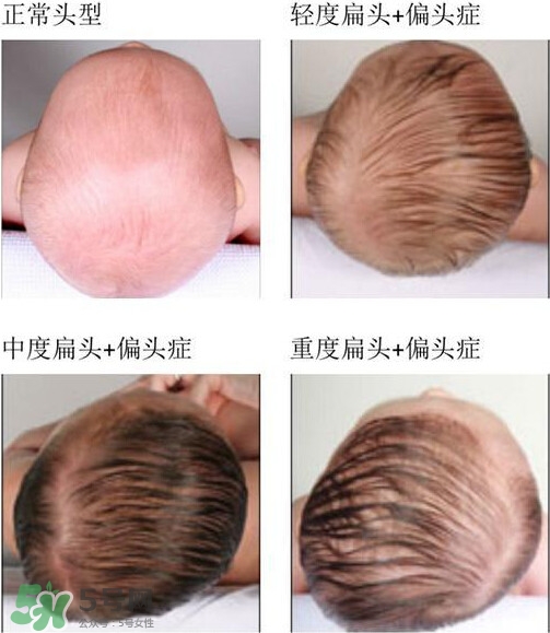寶寶頭型是睡出來的嗎？寶寶頭型矯正最佳時間