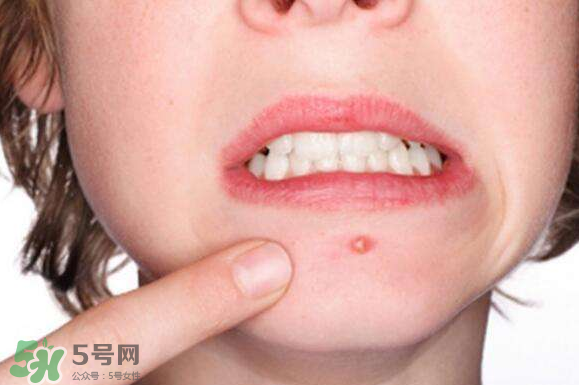 暗瘡可以擠壓嗎？油性和骯臟肌膚會(huì)容易有暗瘡嗎？
