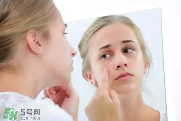 暗瘡可以擠壓嗎？油性和骯臟肌膚會(huì)容易有暗瘡嗎？