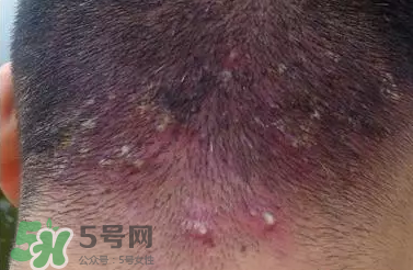 痤瘡和毛囊炎一樣嗎？痤瘡與毛囊炎區(qū)別