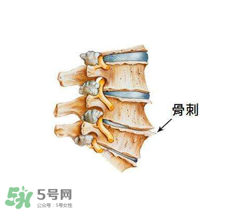 骨刺是怎么形成的？骨刺怎么治療？