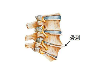 骨刺是怎么形成的？骨刺怎么治療？