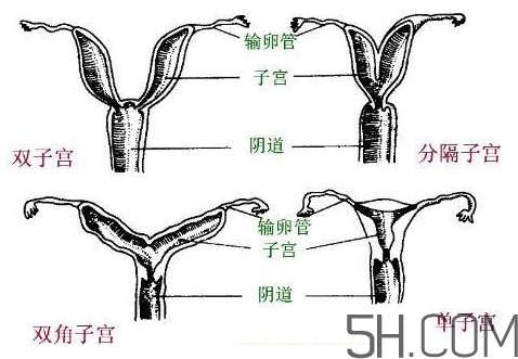 子宮畸形有哪些？子宮畸形有什么影響？