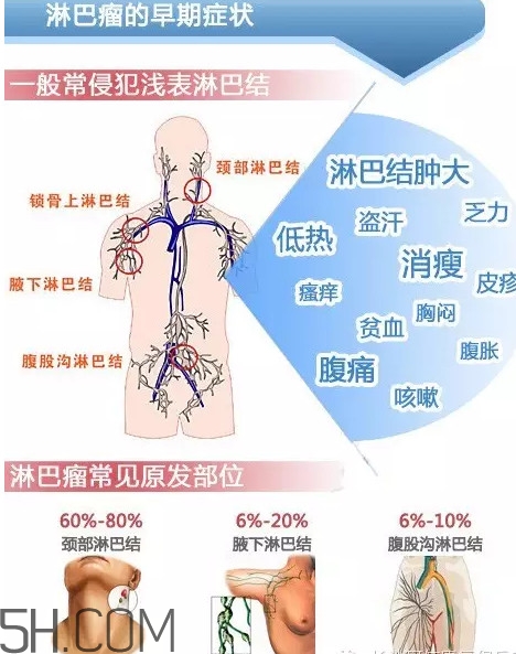 淋巴癌是怎么回事？淋巴癌如何診斷
