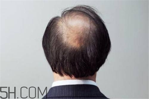 為什么男性比女性更容易脫發(fā)？什么原因?qū)е履行悦摪l(fā)？