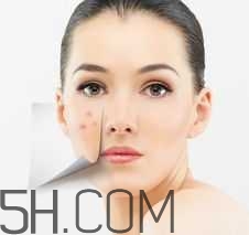 濕熱型痤瘡是什么？怎么調(diào)理濕熱型痤瘡？