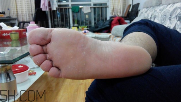 腳氣可以用酒精消毒嗎？腳氣可以用碘伏消毒嗎？