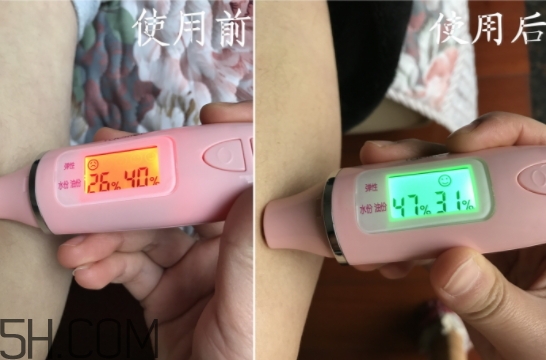 水楊酸可以去黑頭嗎？水楊酸可以去閉口嗎