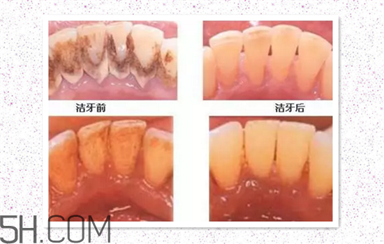超聲波洗牙可以美白牙齒嗎？超聲波洗牙多少錢一次？