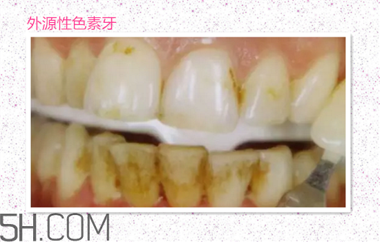 超聲波洗牙可以美白牙齒嗎？超聲波洗牙多少錢一次？