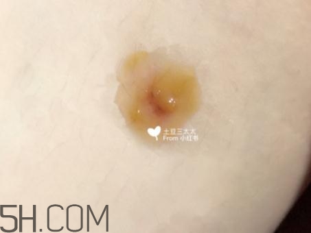 美寶濕潤(rùn)燒傷膏怎么樣？美寶濕潤(rùn)燒傷膏有用嗎？
