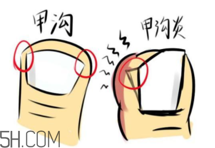 為什么容易得甲溝炎？怎么根治甲溝炎？